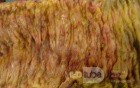 Toxic Dilatation of the Colon Superimposed pseudomembranous colitis involving the
 right colon (17 of 17)