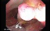 Colonoscopic Polypectomy (10 of 18)