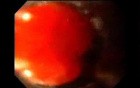 Endoscopy of Mallory Weiss Tear - Banding
