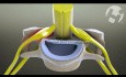 Cervical Radiculopathy