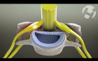 Cervical Radiculopathy