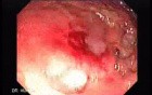 Multiple Rectal Ulcers (4 of 110)