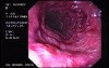 Severe Case Of Ulcerative Colitis (4 of 6)