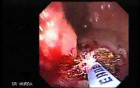 Cap polyposis that resemble a adenocarcinoma of the rectum (5 of 7)