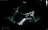 Mitral Valve Regurgitation