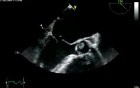 Mitral Valve Regurgitation