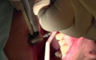 BSB Implant Placement #5, into Mineross Regenerated Bone