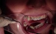 Why Crown Lengthen When You Can Extrude? (Part 1) Tx In Process