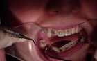 Why Crown Lengthen When You Can Extrude? (Part 1) Tx In Process