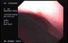 Hemorrhage due status post rubber band ligation of esophageal varices (20 of 25)