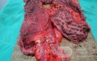Multiple Rectal Ulcers (92 of 110)