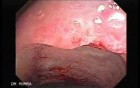 Endoscopic Resection of Giant Tubulo-Villous of the rectum (32 of 35)