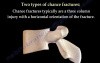 Spine Injuries - Chance Fractures - Video Lecture