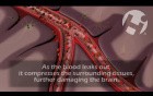 Neurologic Injury