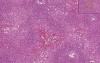 Central Passive Congestion And Centrilobular Hemorrhagic Necrosis