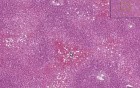 Central Passive Congestion And Centrilobular Hemorrhagic Necrosis