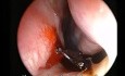 Nosebleed - Cauterization With TCA 50% 