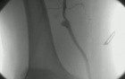 Shunt Aneurysm 