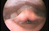 Polyp of a Vocal Cord