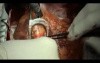 Coronary Artery Bypass Grafting - CABG - Epidural Anaesthesia