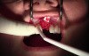 Extraction #9 with GBR-Socket Grafting 