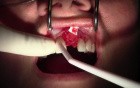 Extraction #9 with GBR-Socket Grafting 