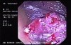 Colon Carcinoma Of The Ascending Colon