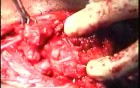 Parotitis Surgery