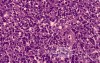 Non-Hodking Lymphoma B Cells. MALT (mucosa associated lymphoid tissue) (3 of 7)