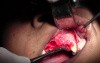 Maxillary Bone Grafting #7-8-10 Sites