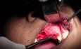 Maxillary Bone Grafting #7-8-10 Sites