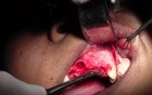 Maxillary Bone Grafting #7-8-10 Sites