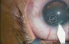 Bilateral Simultanous Cataract Extraction