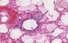 Early Pneumonia