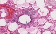 Early Pneumonia