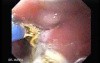 Endoscopic Ablation Of Barrett's Esophagus - 5/6