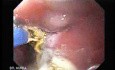 Endoscopic Ablation Of Barrett's Esophagus - 5/6