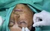 One Side Brow Lift