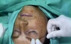 One Side Brow Lift