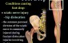 Peroneal Nerve Injury - Video Lecture
