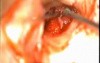 Glomus Tympanicum tumor Excision - Part 1