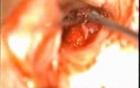 Glomus Tympanicum tumor Excision - Part 1