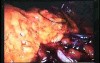 Jejunal Gastrointestinal Stromal tumor (GIST) (68 of 86)