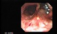 Traqueostomy Fistula (2 of 5)