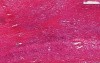 Skin - Rheumatoid Nodule