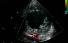 Left Ventricule Non Compaction