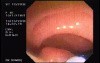 Tubulo - Villous Adenoma - Endoscopy (12 of 28)