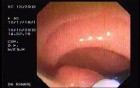 Tubulo - Villous Adenoma - Endoscopy (12 of 28)
