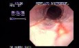Esophagitis - Mild Case