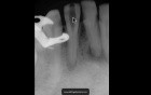 Calcified Incisor - How To Read A Near Miss Radiograph